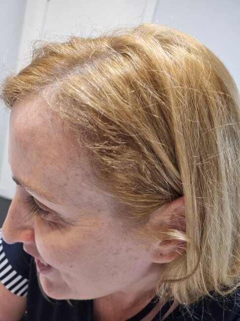 Ven para tu tratamiento de alopecia en Capilar innovation Clinic en Sevilla