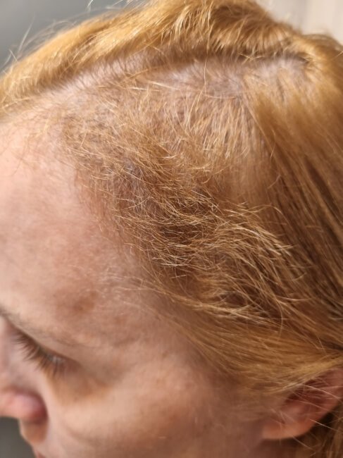 Ven para tu tratamiento de alopecia en Capilar innovation Clinic en Madrid