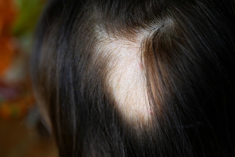Para tu alopecia femenina, tratamientos capilares en Sevilla en Capilar innovation Clinic