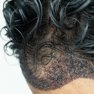¿Qué diferencias hay entre un procedimiento de injerto capilar y el trasplante de pelo_