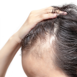 La alopecia difusa consiste en la caída de pelo homogénea y visible en toda la cabeza