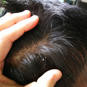 La dermatitis seborreica puede ser un factor causante de la caída del cabello