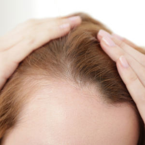¿Es posible revertir los efectos de la alopecia androgénica en mujeres